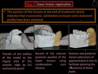 Step 5 : lower incisor registration
Transfer of the midline
of the model to the
lingual area of the
alveolar ridge by 0.5
mechanical pencil.
Record of the anterior
posterior position of the
lower incisors using
condensation cure
silicone.
Anterior and posterior
incisor extensions of
approximately 6 mm to
facilitate planning the
movement of these
teeth.
 The position of the incisors at the end of treatment clearly
indicates that a successful, satisfactory occlusion and a balanced
profile have been achieved.
 