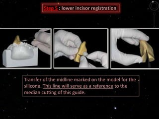 Transfer of the midline marked on the model for the
silicone. This line will serve as a reference to the
median cutting of this guide.
Step 5 : lower incisor registration
 