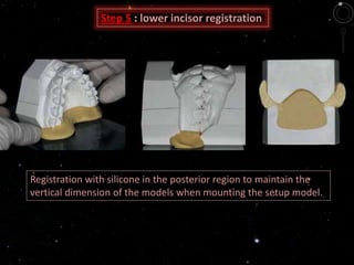 Registration with silicone in the posterior region to maintain the
vertical dimension of the models when mounting the setup model.
Step 5 : lower incisor registration
 