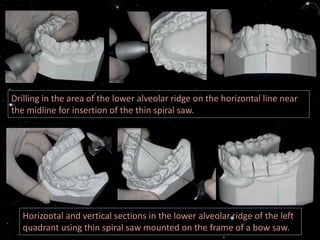 Drilling in the area of the lower alveolar ridge on the horizontal line near
the midline for insertion of the thin spiral saw.
Horizontal and vertical sections in the lower alveolar ridge of the left
quadrant using thin spiral saw mounted on the frame of a bow saw.
 