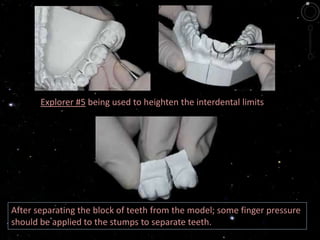 Explorer #5 being used to heighten the interdental limits
After separating the block of teeth from the model; some finger pressure
should be applied to the stumps to separate teeth.
 