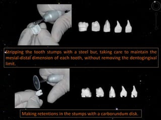 Stripping the tooth stumps with a steel bur, taking care to maintain the
mesial-distal dimension of each tooth, without removing the dentogingival
limit.
Making retentions in the stumps with a carborundum disk.
 