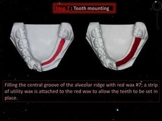 Step 7 : Tooth mounting
Filling the central groove of the alveolar ridge with red wax #7; a strip
of utility wax is attached to the red wax to allow the teeth to be set in
place.
 