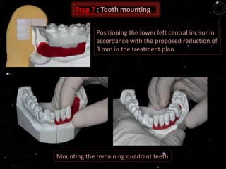 Positioning the lower left central incisor in
accordance with the proposed reduction of
3 mm in the treatment plan.
Mounting the remaining quadrant teeth
Step 7 : Tooth mounting
 