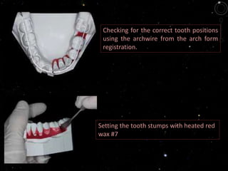 Checking for the correct tooth positions
using the archwire from the arch form
registration.
Setting the tooth stumps with heated red
wax #7
 