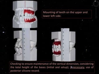 Mounting of teeth on the upper and
lower left side.
Checking to ensure maintenance of the vertical dimension, considering
the total height of the bases (initial and setup); if necessary, use of
posterior silicone record.
 