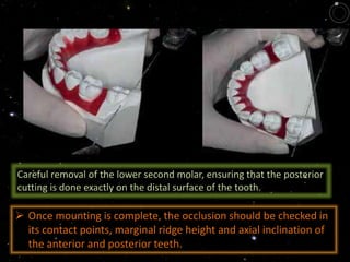 Careful removal of the lower second molar, ensuring that the posterior
cutting is done exactly on the distal surface of the tooth.
 Once mounting is complete, the occlusion should be checked in
its contact points, marginal ridge height and axial inclination of
the anterior and posterior teeth.
 