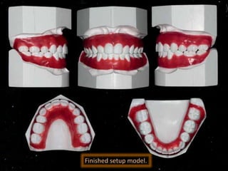 Finished setup model.
 