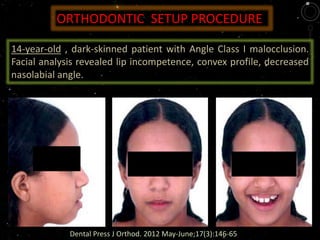 14-year-old , dark-skinned patient with Angle Class I malocclusion.
Facial analysis revealed lip incompetence, convex profile, decreased
nasolabial angle.
ORTHODONTIC SETUP PROCEDURE
Dental Press J Orthod. 2012 May-June;17(3):146-65
 