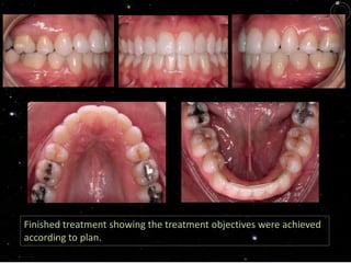 Finished treatment showing the treatment objectives were achieved
according to plan.
 