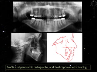 Profile and panoramic radiographs, and final cephalometric tracing
 