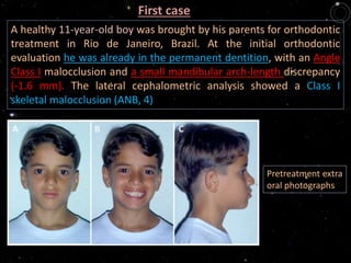 A healthy 11-year-old boy was brought by his parents for orthodontic
treatment in Rio de Janeiro, Brazil. At the initial orthodontic
evaluation he was already in the permanent dentition, with an Angle
Class I malocclusion and a small mandibular arch-length discrepancy
(-1.6 mm). The lateral cephalometric analysis showed a Class I
skeletal malocclusion (ANB, 4)
Pretreatment extra
oral photographs
First case
 