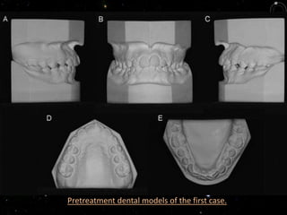 Pretreatment dental models of the first case.
 