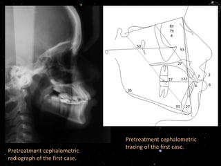 Pretreatment cephalometric
radiograph of the first case.
Pretreatment cephalometric
tracing of the first case.
 
