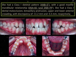 She had a Class I skeletal pattern (ANB=3°), with a good maxillo-
mandibular relationship (SNA=82 ‫؛‬and SNB=79°). She had a Class I
dental malocclusion, bimaxillary protrusion, upper and lower anterior
crowding, with discrepancy of -11.2 mm and -5.5 mm, respectively.
 