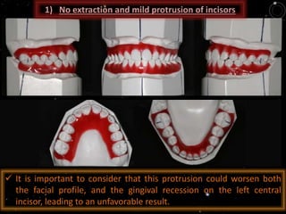  It is important to consider that this protrusion could worsen both
the facial profile, and the gingival recession on the left central
incisor, leading to an unfavorable result.
1) No extraction and mild protrusion of incisors
 