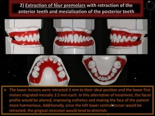 2) Extraction of four premolars with retraction of the
anterior teeth and mesialization of the posterior teeth
 The lower incisors were retracted 3 mm to their ideal position and the lower first
molars migrated mesially 3.5 mm each. In this alternative of treatment, the facial
profile would be altered, improving esthetics and making the face of the patient
more harmonious. Additionally, since the left lower central incisor would be
retracted, the gingival recession would tend to diminish.
 