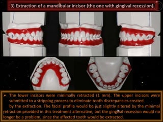 3) Extraction of a mandibular incisor (the one with gingival recession).
 The lower incisors were minimally retracted (1 mm). The upper incisors were
submitted to a stripping process to eliminate tooth discrepancies created
by the extraction. The facial profile would be just slightly altered by the minimal
retraction provided in this treatment alternative, but the gingival recession would no
longer be a problem, since the affected tooth would be extracted.
 