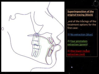 Superimposition of the
original tracing (black)
and of the tracings of the
treatment options for the
first case:
1) No extraction (blue)
2) Four premolars
extraction (green)
3) One lower incisor
extraction (red)
 