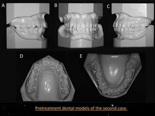 Pretreatment dental models of the second case.
 