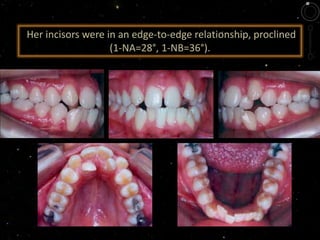 Her incisors were in an edge-to-edge relationship, proclined
(1-NA=28°, 1-NB=36°).
 