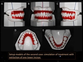 Setup models of the second case: simulation of treatment with
extraction of one lower incisor.
 
