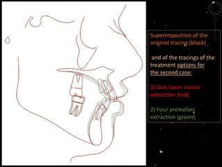 Superimposition of the
original tracing (black)
and of the tracings of the
treatment options for
the second case:
1) One lower incisor
extraction (red)
2) Four premolars
extraction (green).
 