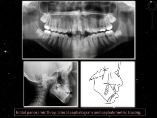 Initial panoramic X-ray, lateral cephalogram and cephalometric tracing.
 