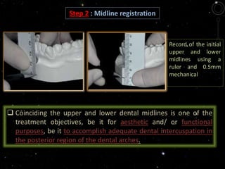 Step 2 : Midline registration
Record of the initial
upper and lower
midlines using a
ruler and 0.5mm
mechanical
pencil
 Coinciding the upper and lower dental midlines is one of the
treatment objectives, be it for aesthetic and/ or functional
purposes, be it to accomplish adequate dental intercuspation in
the posterior region of the dental arches.
 