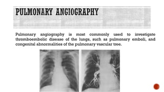 Pulmonary angiography is most commonly used to investigate
thromboembolic disease of the lungs, such as pulmonary emboli, and
congenital abnormalities of the pulmonary vascular tree.
 