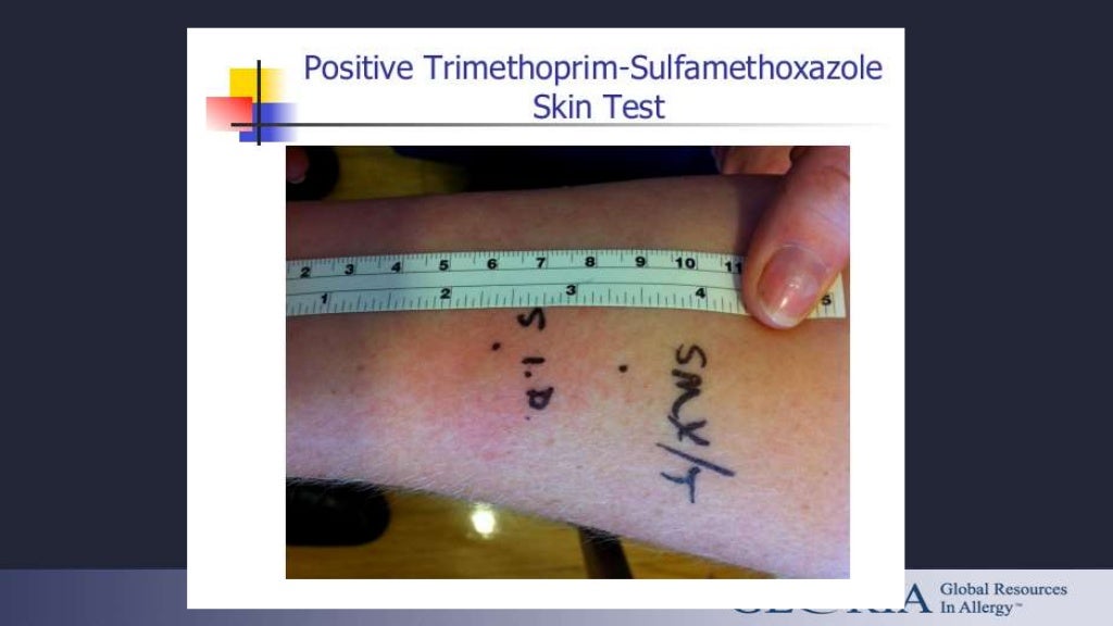 Diagnostic test for drug allergy