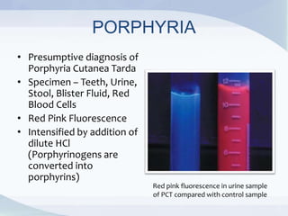 PORPHYRIA
• Presumptive diagnosis of
Porphyria Cutanea Tarda
• Specimen – Teeth, Urine,
Stool, Blister Fluid, Red
Blood Cells
• Red Pink Fluorescence
• Intensified by addition of
dilute HCl
(Porphyrinogens are
converted into
porphyrins)
Red pink fluorescence in urine sample
of PCT compared with control sample
 