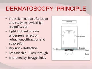 DERMATOSCOPY -PRINCIPLE
• Transillumination of a lesion
and studying it with high
magnification
• Light incident on skin
undergoes reflection,
refraction, diffraction and
absorption
• Dry skin – Reflection
• Smooth skin – Pass through
• Improved by linkage fluids
 