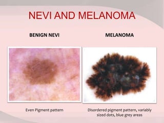 NEVI AND MELANOMA
BENIGN NEVI MELANOMA
Even Pigment pattern Disordered pigment pattern, variably
sized dots, blue grey areas
 
