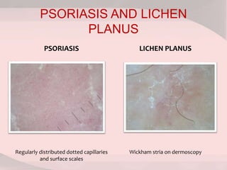 PSORIASIS AND LICHEN
PLANUS
PSORIASIS LICHEN PLANUS
Regularly distributed dotted capillaries
and surface scales
Wickham stria on dermoscopy
 
