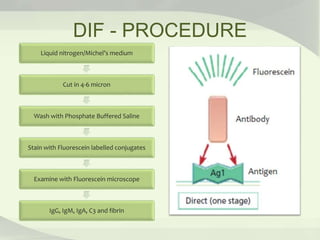 DIF - PROCEDURE
Liquid nitrogen/Michel’s medium
Cut in 4-6 micron
Wash with Phosphate Buffered Saline
Stain with Fluorescein labelled conjugates
Examine with Fluorescein microscope
IgG, IgM, IgA, C3 and fibrin
 