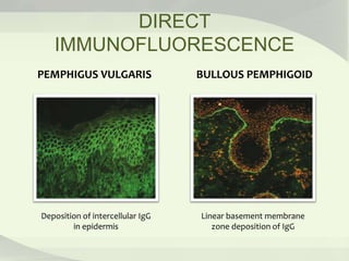 DIRECT
IMMUNOFLUORESCENCE
PEMPHIGUS VULGARIS BULLOUS PEMPHIGOID
Deposition of intercellular IgG
in epidermis
Linear basement membrane
zone deposition of IgG
 