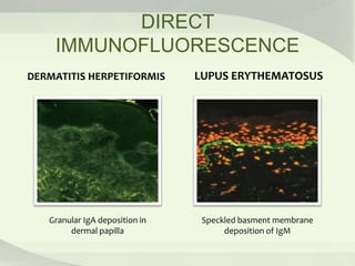 DIRECT
IMMUNOFLUORESCENCE
DERMATITIS HERPETIFORMIS LUPUS ERYTHEMATOSUS
Granular IgA deposition in
dermal papilla
Speckled basment membrane
deposition of IgM
 
