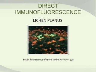 DIRECT
IMMUNOFLUORESCENCE
LICHEN PLANUS
Bright fluorescence of cytoid bodies with anti IgM
 
