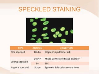 SPECKLED STAINING
TYPE ANTIGEN CONDITION
Fine speckled Ro, La Sjogren’s syndrome, SLE
Coarse speckled
u1RNP Mixed Connective tissue disorder
Sm SLE
Atypical speckled Scl-70 Systemic Sclerosis – severe from
 