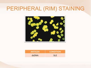 PERIPHERAL (RIM) STAINING
ANTIGEN CONDITION
dsDNA SLE
 