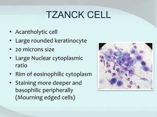 TZANCK CELL
• Acantholytic cell
• Large rounded keratinocyte
• 20 microns size
• Large Nuclear cytoplasmic
ratio
• Rim of eosinophilic cytoplasm
• Staining more deeper and
basophilic peripherally
(Mourning edged cells)
 