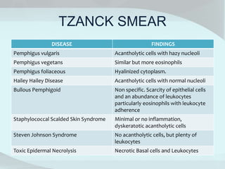TZANCK SMEAR
DISEASE FINDINGS
Pemphigus vulgaris Acantholytic cells with hazy nucleoli
Pemphigus vegetans Similar but more eosinophils
Pemphigus foliaceous Hyalinized cytoplasm.
Hailey Hailey Disease Acantholytic cells with normal nucleoli
Bullous Pemphigoid Non specific. Scarcity of epithelial cells
and an abundance of leukocytes
particularly eosinophils with leukocyte
adherence
Staphylococcal Scalded Skin Syndrome Minimal or no inflammation,
dyskeratotic acantholytic cells
Steven Johnson Syndrome No acantholytic cells, but plenty of
leukocytes
Toxic Epidermal Necrolysis Necrotic Basal cells and Leukocytes
 