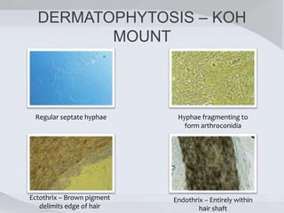 DERMATOPHYTOSIS – KOH
MOUNT
Regular septate hyphae Hyphae fragmenting to
form arthroconidia
Ectothrix – Brown pigment
delimits edge of hair
Endothrix – Entirely within
hair shaft
 