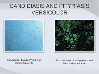 CANDIDIASIS AND PITYRIASIS
VERSICOLOR
Candidiasis – Budding Yeast and
Slender filaments
Pityriasis Versicolor – Spaghetti and
Meat ball appearance
 