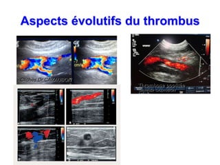 Diagnostic ultrasonore des thromboses veineuses profondes