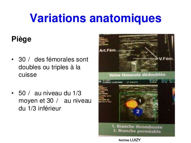 Lablation hertzienne à la varicosité les rappels