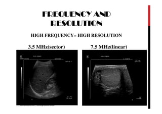 FREQUENCY AND
RESOLUTION
HIGH FREQUENCY= HIGH RESOLUTION
3.5 MHz(sector) 7.5 MHz(linear)
MAAJIDMALIKOFFICIAL@GMAIL.COM
 