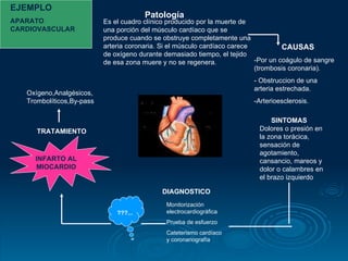 Es el cuadro clínico producido por la muerte de una porción del músculo cardíaco que se produce cuando se obstruye completamente una arteria coronaria. Si el músculo cardíaco carece de oxígeno durante demasiado tiempo, el tejido de esa zona muere y no se regenera.  -Por un coágulo de sangre (trombosis coronaria). - Obstruccion de una arteria estrechada. -Arterioesclerosis. Dolores o presión en la zona torácica, sensación de agotamiento, cansancio, mareos y dolor o calambres en el brazo izquierdo  Monitorización electrocardiográfica  Prueba de esfuerzo  Cateterismo cardíaco y coronariografía  Patología CAUSAS SINTOMAS ???... DIAGNOSTICO EJEMPLO APARATO CARDIOVASCULAR TRATAMIENTO Oxígeno,Analgésicos, Trombolíticos,By-pass  INFARTO AL MIOCARDIO 