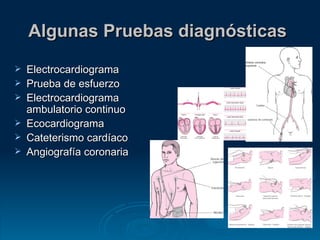 Algunas Pruebas diagnósticas   Electrocardiograma  Prueba de esfuerzo  Electrocardiograma ambulatorio continuo  Ecocardiograma  Cateterismo cardíaco  Angiografía coronaria  